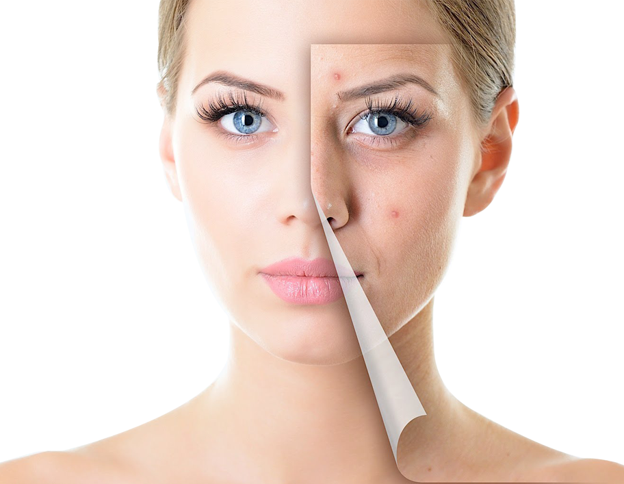 Acne Solutions