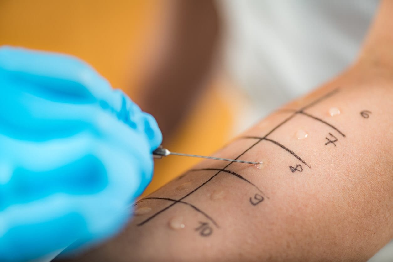 Allergy Test