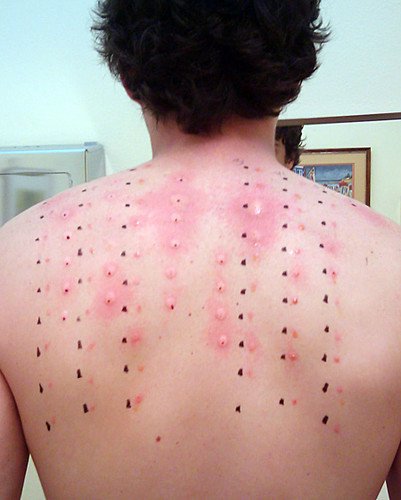 Skin Allergy
