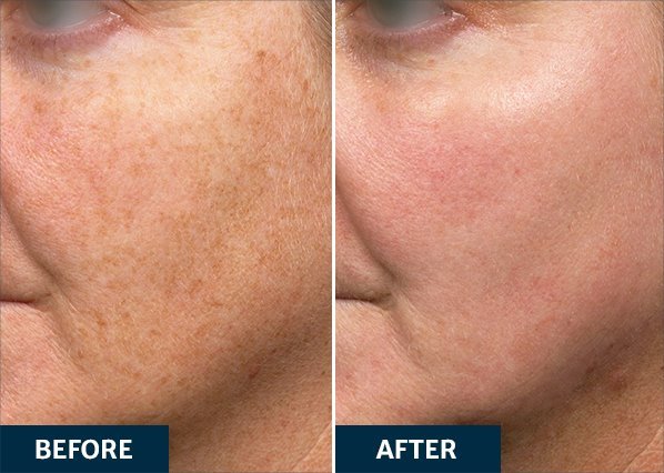 Laser Treatment