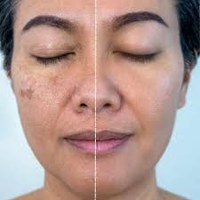 Pigmentation