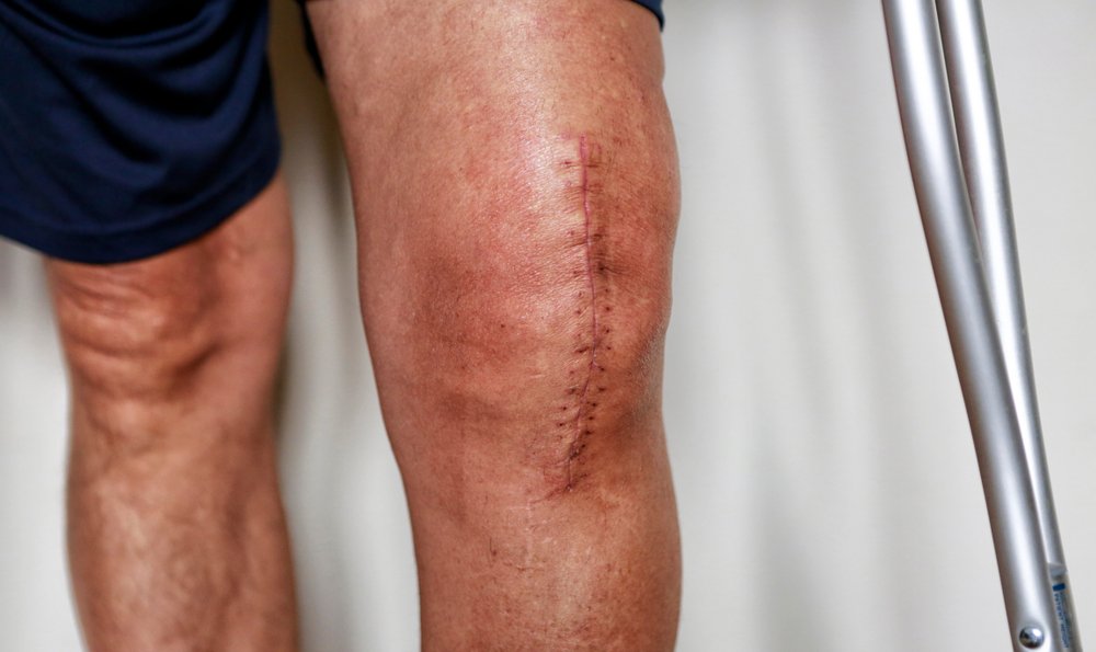 Knee Replacement Insights