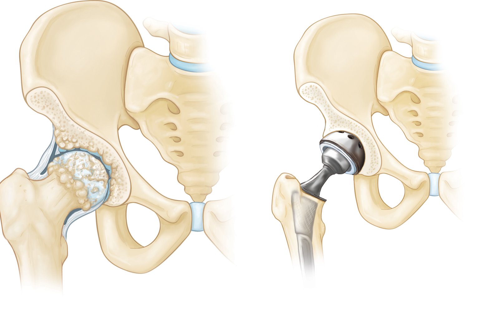 Joint Replacement