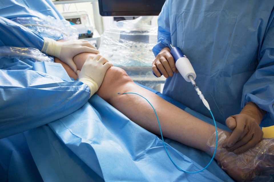 Stent Placement